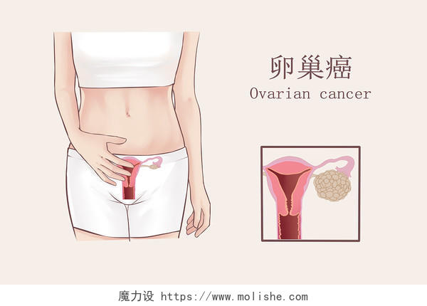 写实风女性子宫卵巢疾病症状卵巢癌示意插画